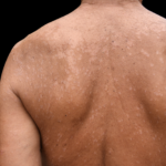 Le pityriasis versicolor